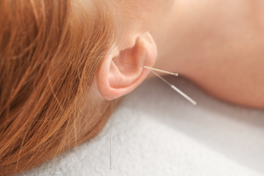 Eine Patientin, mit Nadeln im Ohr